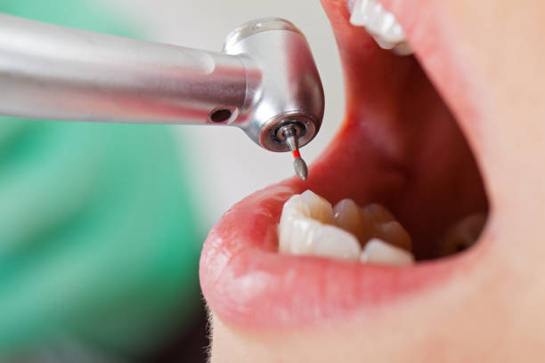 Best Emergency Tooth Extraction in Valley City, ND